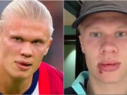 Erling Haaland subisce uno strano infortunio al viso sull’autobus della squadra norvegese