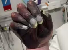 La madre muore dopo l’amputazione del braccio mentre i medici liquidano la mano annerita come “inchiostro di giornale”