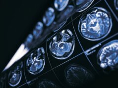 E se il cancro fosse la chiave per nuovi trattamenti per la malattia di Alzheimer?