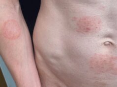 Un fungo STI si sta diffondendo negli Stati Uniti