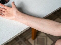 La più grande epidemia di morbillo della storia recente segnalata nel campus universitario sudoccidentale