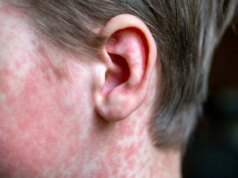 Il CDC si rifiuta di assumersi la colpa per il morbillo che sta andando fuori controllo