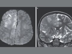 Ecco come appare un cervello distrutto dal morbillo