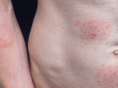 Lo Stato conferma l’epidemia di infezione fungina a trasmissione sessuale, gli esperti invitano alla cautela