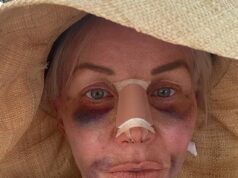 La star di RHONJ Margaret Josephs, 58 anni, svela il lavoro al naso dopo un lungo restyling della chirurgia plastica