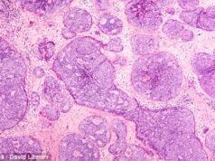 Beverley Callard rivela che la sua mente è “maniacale” mentre si prepara a tornare al lavoro in un aggiornamento sulla salute dopo l’intervento chirurgico per il cancro al seno